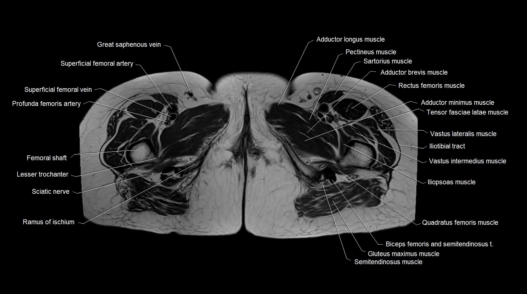 MRI 3T pelvis axial cross section anatomy image 33.webp